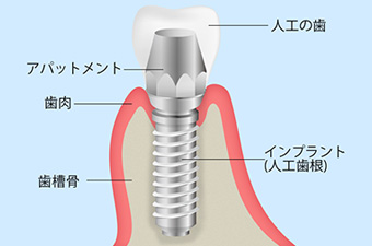 インプラント