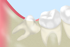 親知らずの抜歯