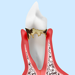 中度歯周炎