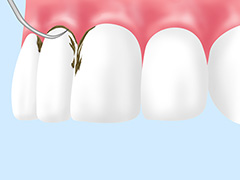 歯周ポケットそうは術